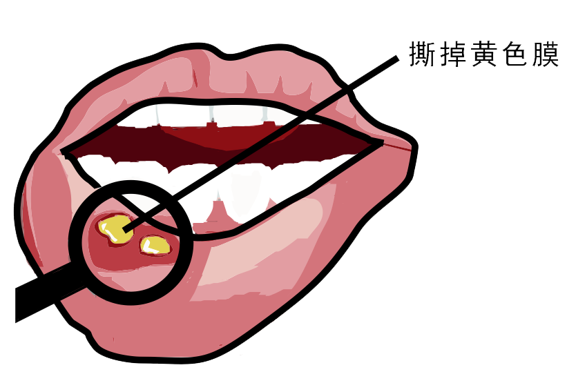 經(jīng)?？谇粷?，真的只是缺維生素嗎？