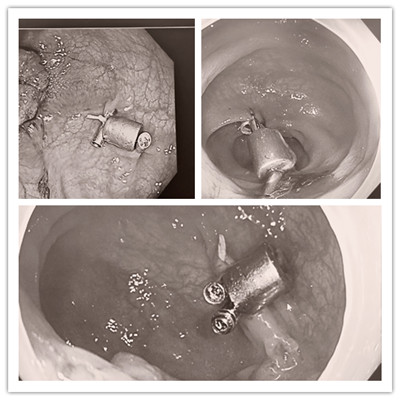 消化病醫(yī)院內(nèi)外科聯(lián)合開展3例“磁環(huán)預(yù)標(biāo)記輔助腹腔鏡結(jié)、直腸癌根治術(shù)”