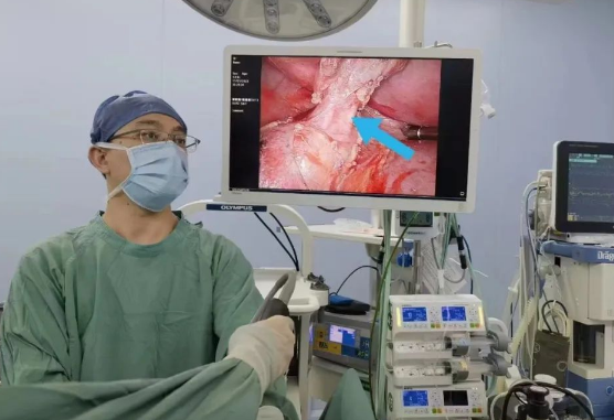 30歲小伙持續(xù)發(fā)燒咳嗽，原來是多長一塊肺......