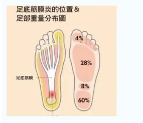 每年新生數(shù)百萬足底筋膜炎患者！國際醫(yī)學(xué)專家提醒：跑步要選擇合適的鞋